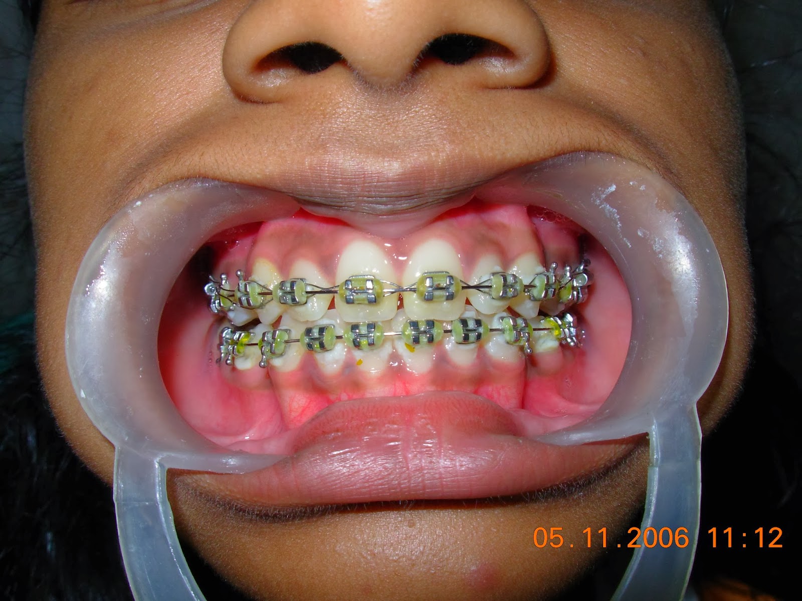 P.K. Dental Clinic CASE Orthodontic treatment Straight wire MBT