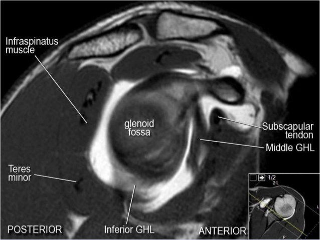 MRI Musculo-Skeletal Section: MRI anatomy of the shoulder (sagittal view).