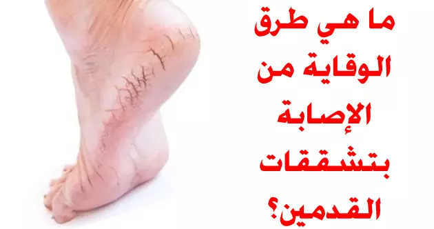 طرق الوقاية من تشققات القدمين تشققات القدمين