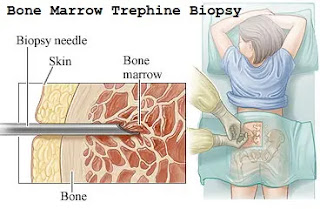 Bone Marrow Examination- Bone Marrow Trephine Biopsy