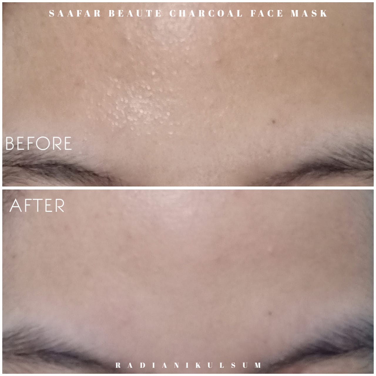 before-after pemakaian masker charcoal Saafar Beaute di dahi