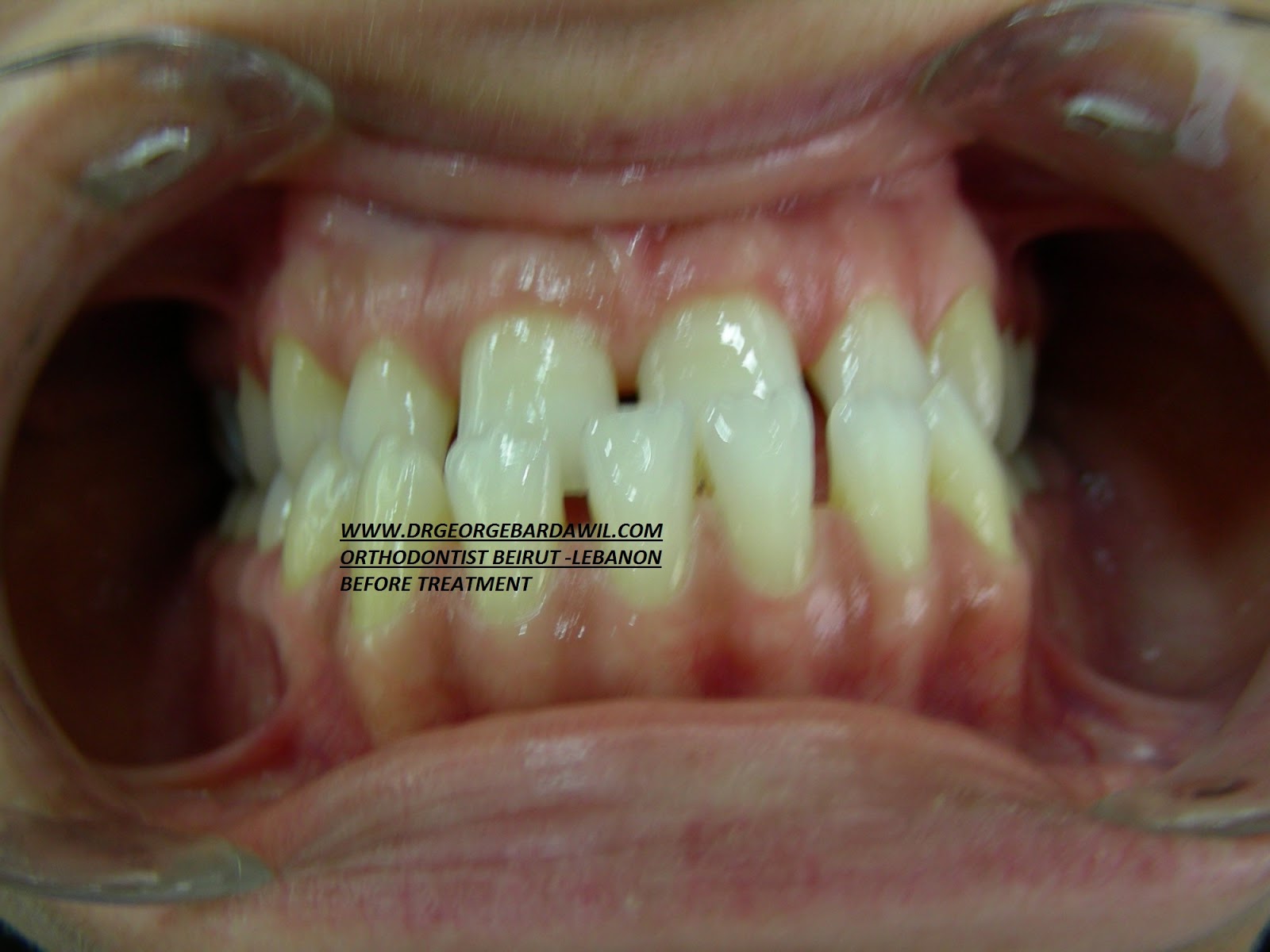 E. BardawilOrthodontistInvisalign Diamond level underbite