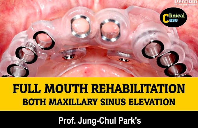 FULL MOUTH REHABILITATION with both maxillary sinus elevation - Prof. Jung-Chul Park's 