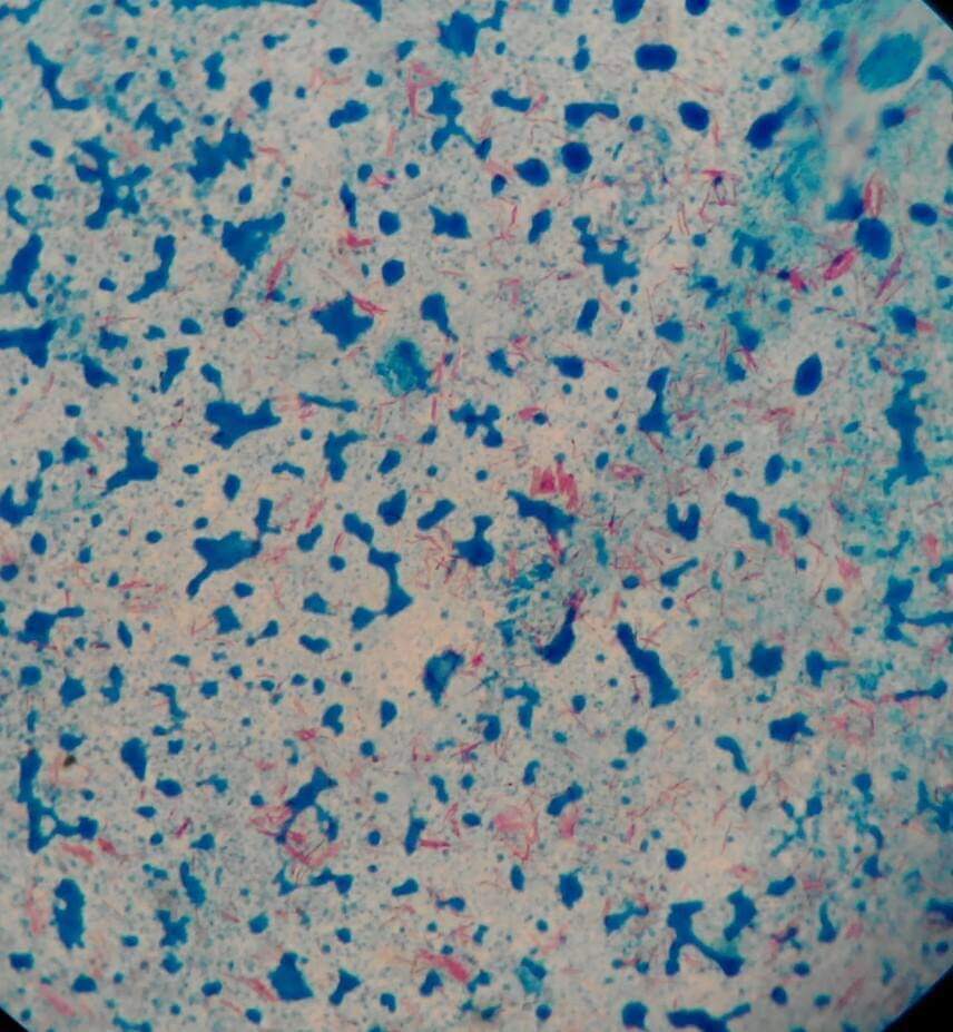 Sekilas Tentang Pewarnaan Bta Dari Ahmadmusyaffaahdanlab Dpc Patelki Sumut