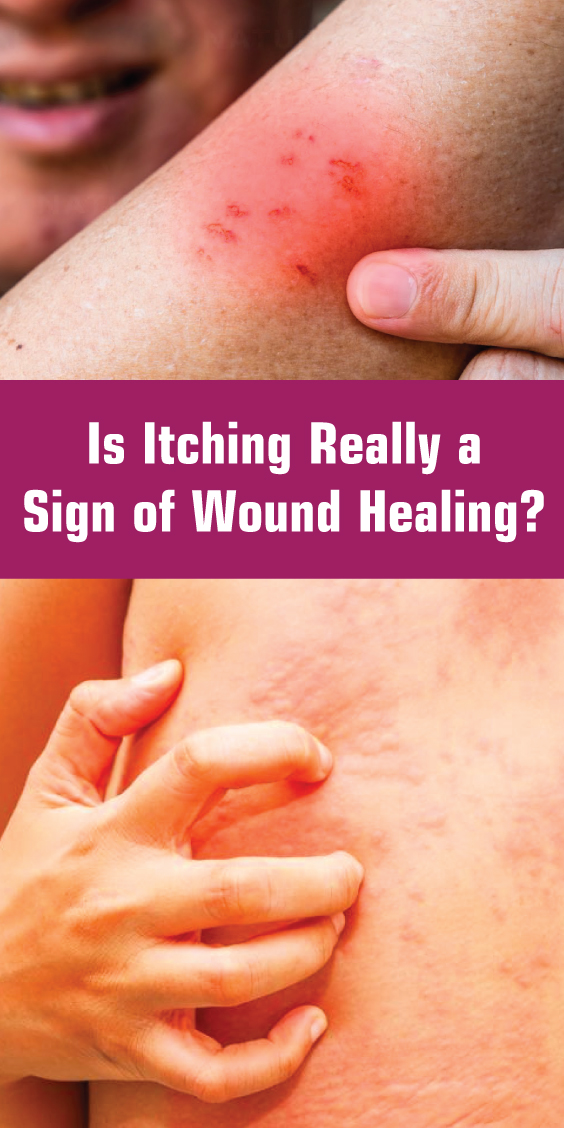 Is Itching Really a Sign of Wound Healing? KrobKnea