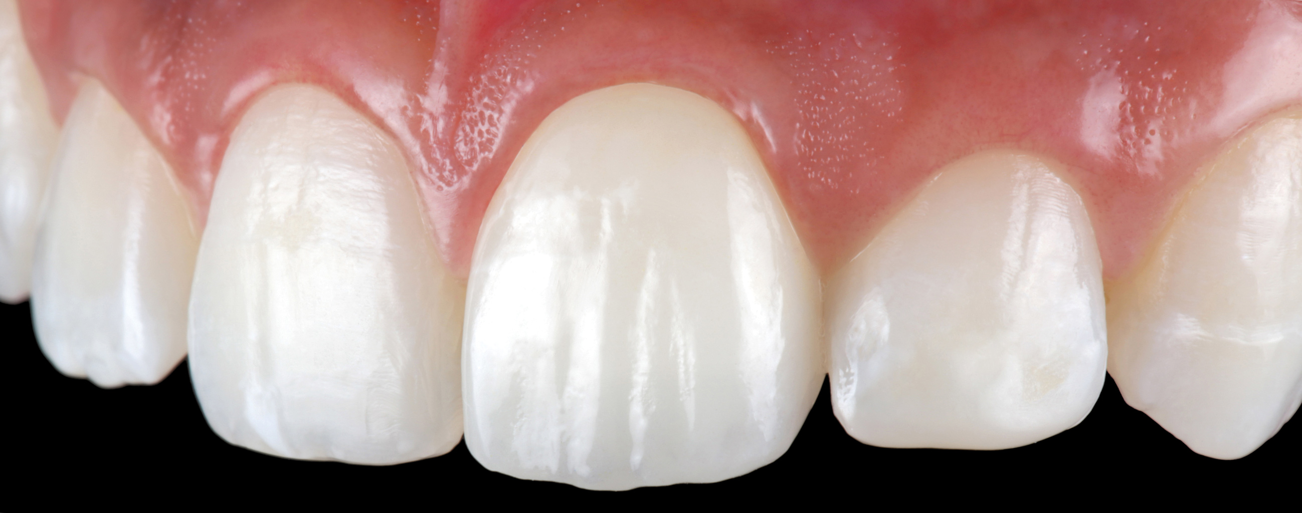 Do Crowns Look False? Dr. Bharat Katarmal Dental & Implant Clinic