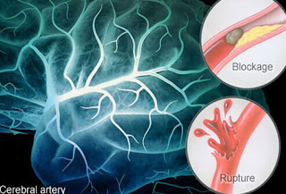 Obat Jitu Stroke, Obat Herbal Untuk Sakit Stroke Ringan, Obat Alami Sakit Stroke, Obat Stroke Kulit Manggis, Makalah Penyakit Stroke Pada Lansia, Tips Mengobati Gejala Stroke, Penyakit Stroke Hemoragik Pdf, Obat Stroke Muka, Obat Tradisional Mengobati Stroke, Akibat Penyakit Stroke Ringan, Obat Gejala Stroke Ringan, Penyakit Stroke Non Hemoragic, Penyebab Terjadinya Penyakit Stroke Ringan, 10 Obat Alami Penyakit Stroke, Artikel Tentang Penyakit Stroke Pdf 