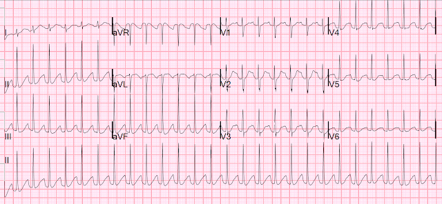 Dr Smith S Ecg Blog Qt Correction Formulas Compared To The Rule