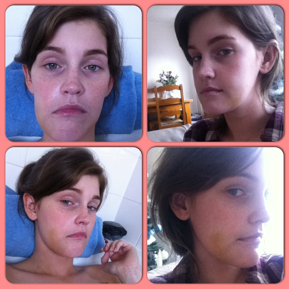 A Guide to Surviving Orthognathic Surgery Recovery from Plate & Screw