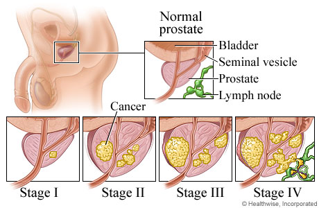 prostatita tip 3 a)