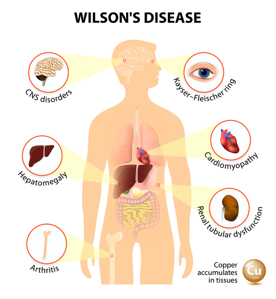 Detailed Description of Wilson Disease by Dr Arun Aggarwal
