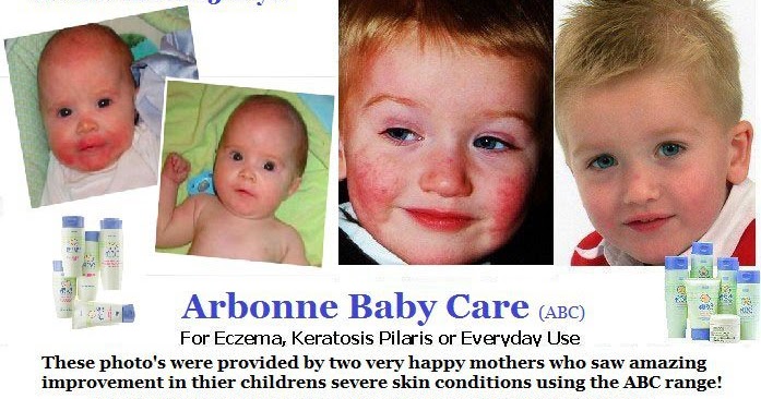 arbonne eczema cream