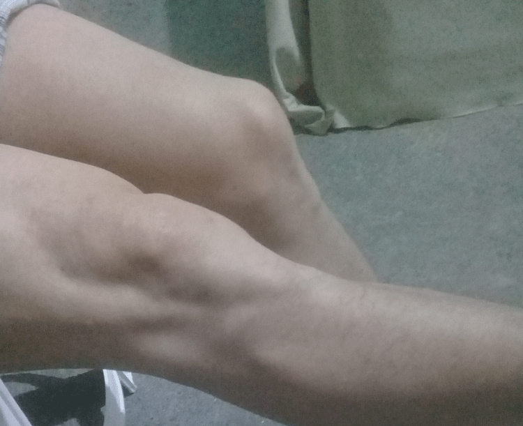 Hialuronato sódico inyectable, calma dolores articulares Hialuronato sódico inyectable