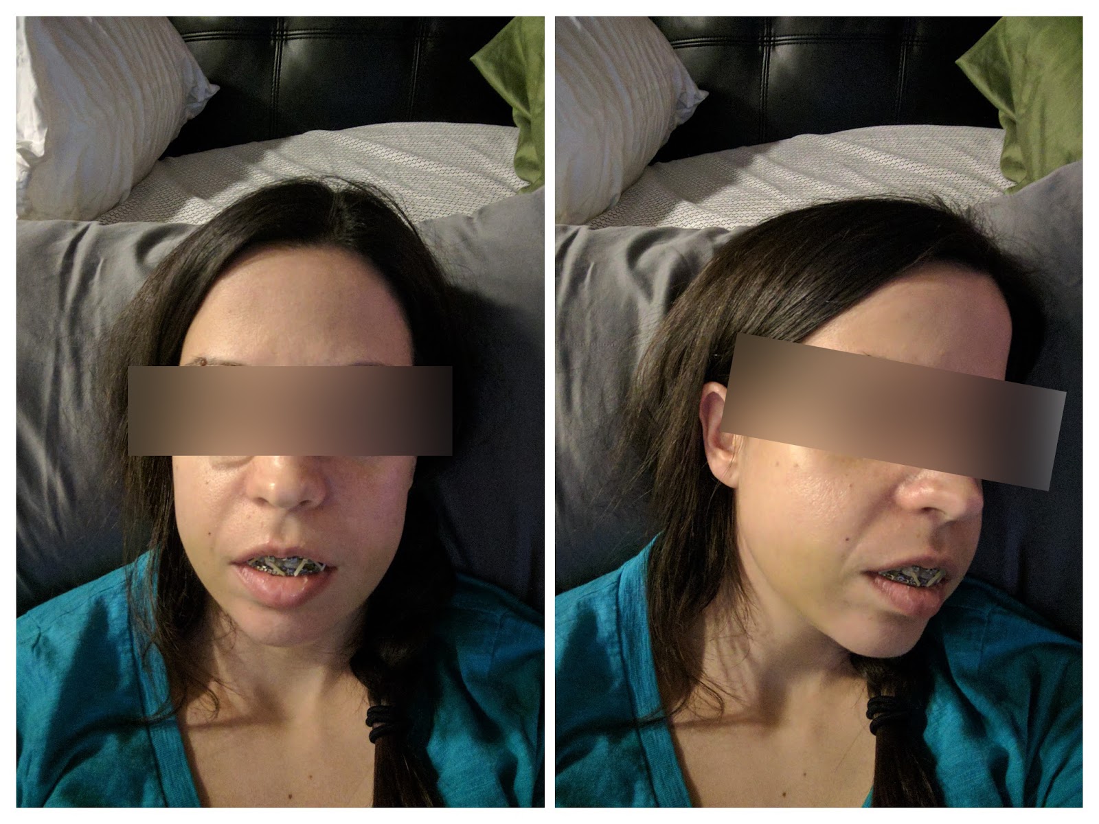 My Story Double Jaw Surgery and Septoplasty Photos