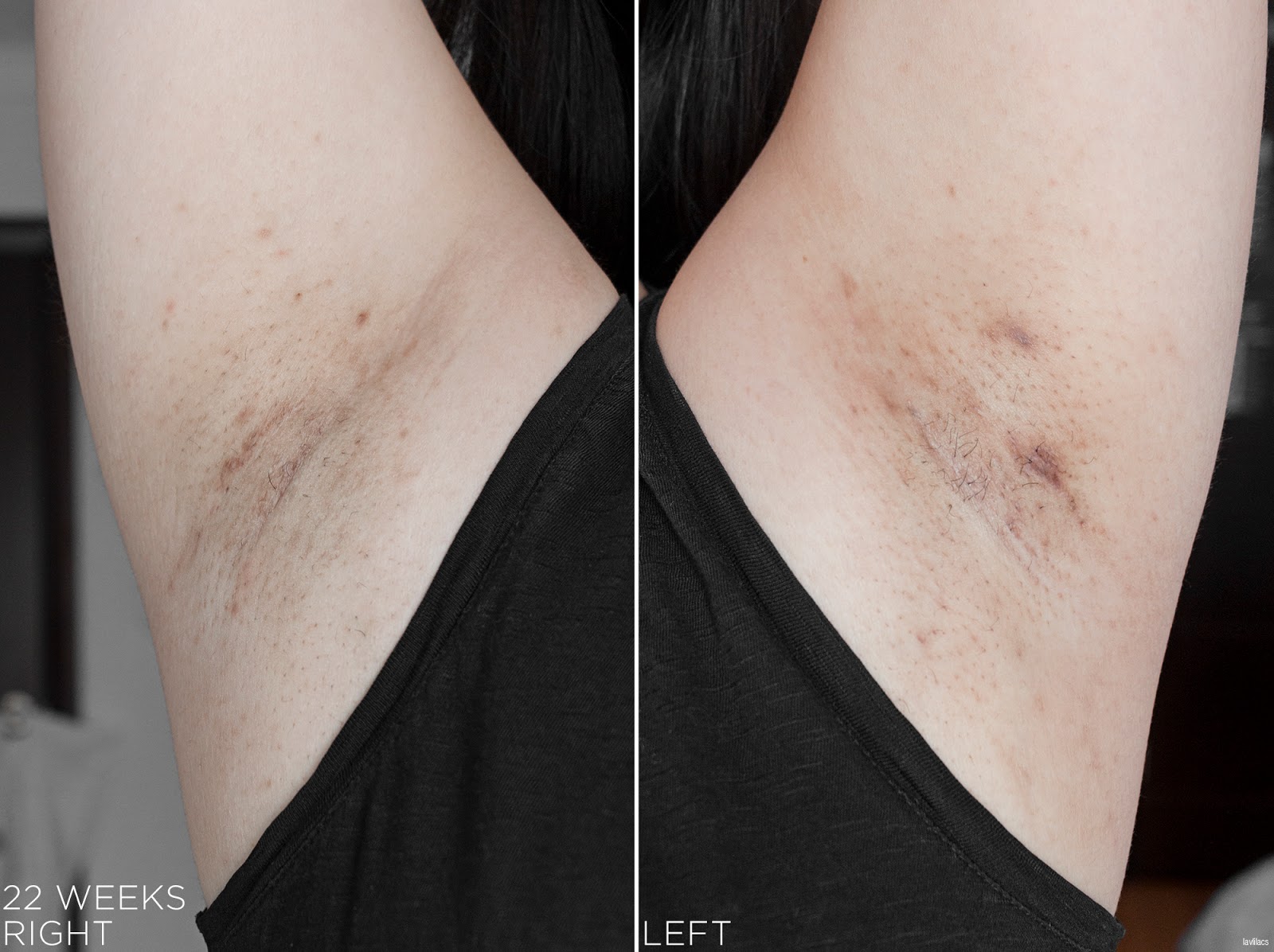 tria Hair Removal Laser Armpits Hair 22 Weeks, 5 months