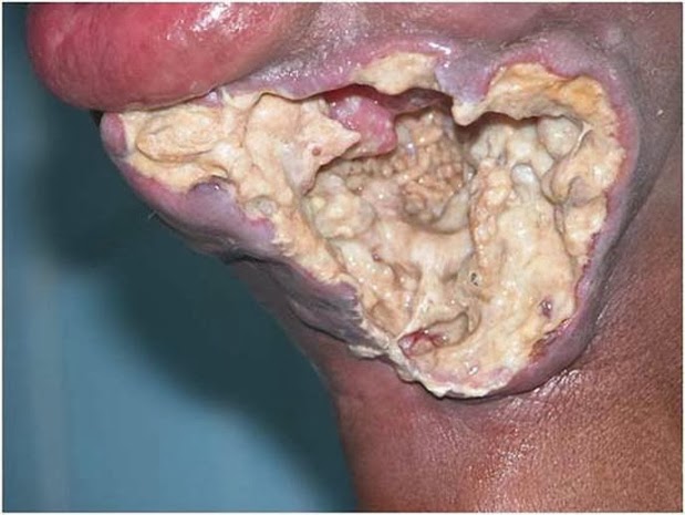 Oral Wound 29