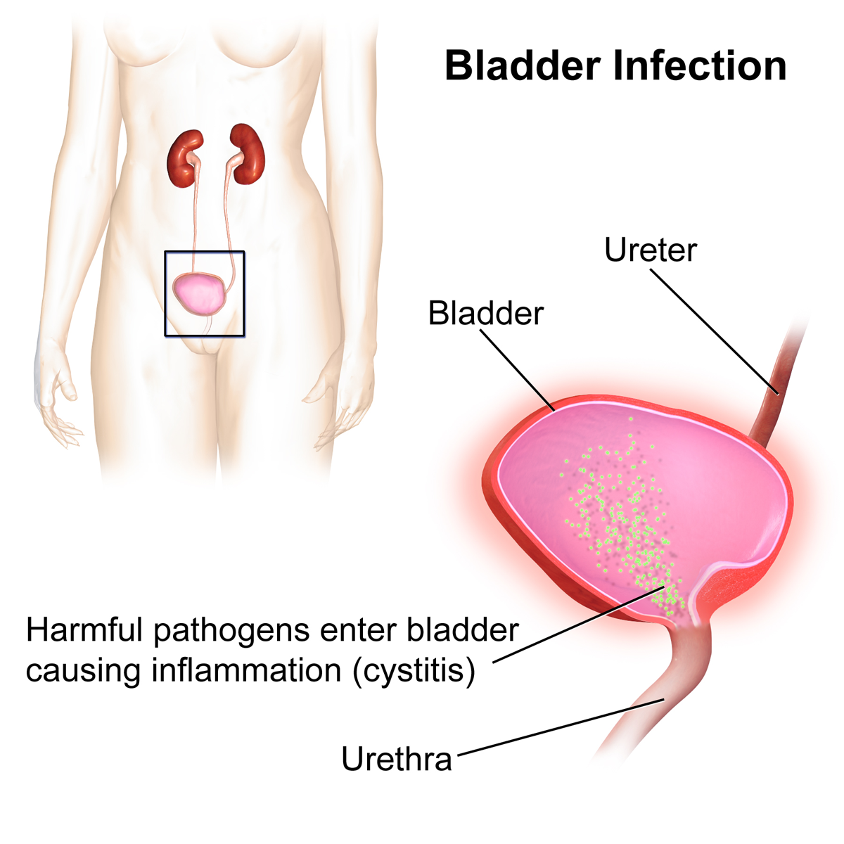 How to Treat a UTI at Home