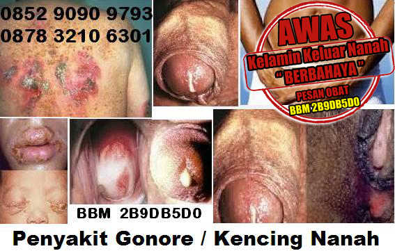 Pengobatan Gonorrhea & Chlamydia Dan Bahaya Kencing Nanah Pengobatan Gonorrhea & Chlamydia Dan Bahaya Kencing Nanah