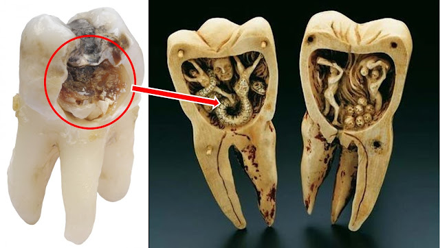 Ulat Gigi Penyebab Sakit Gigi dan Gigi Berlubang, Mitos atau Fakta