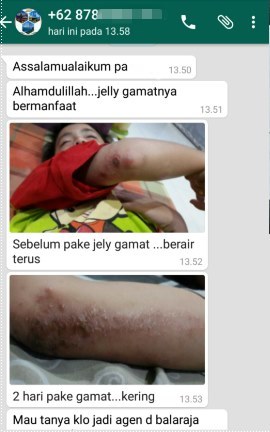 Cara Mengobati Bentol Bernanah Di Tangan Dan Kaki Secara Alami Terbukti Ampuh - TESTIMONI QNC JELLY GAMAT Cara Mengobati Bentol Bernanah Di Tangan Dan Kaki Secara Alami Terbukti Ampuh - TESTIMONI QNC JELLY GAMAT