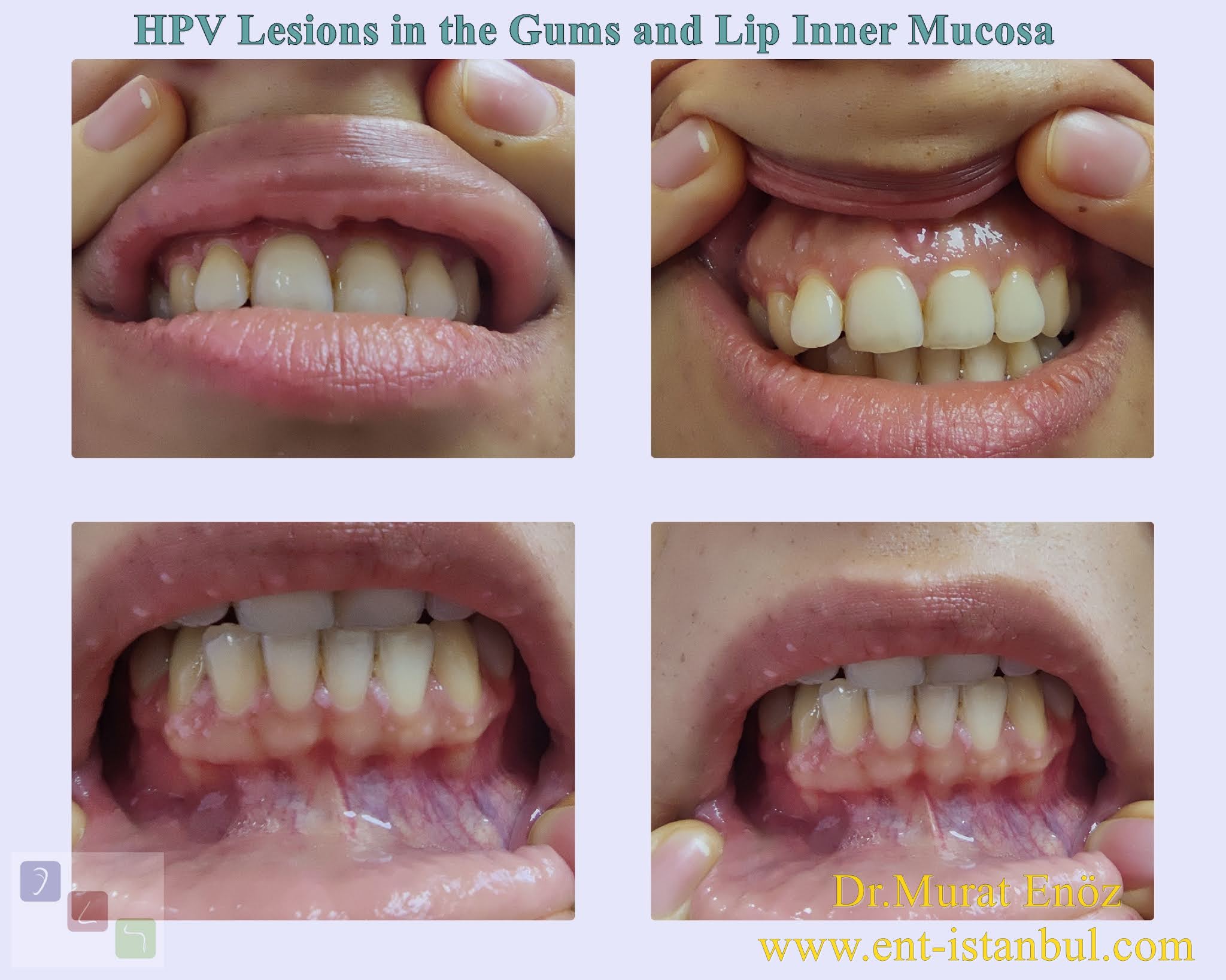 Removal of papilloma in mouth, Removal of papilloma