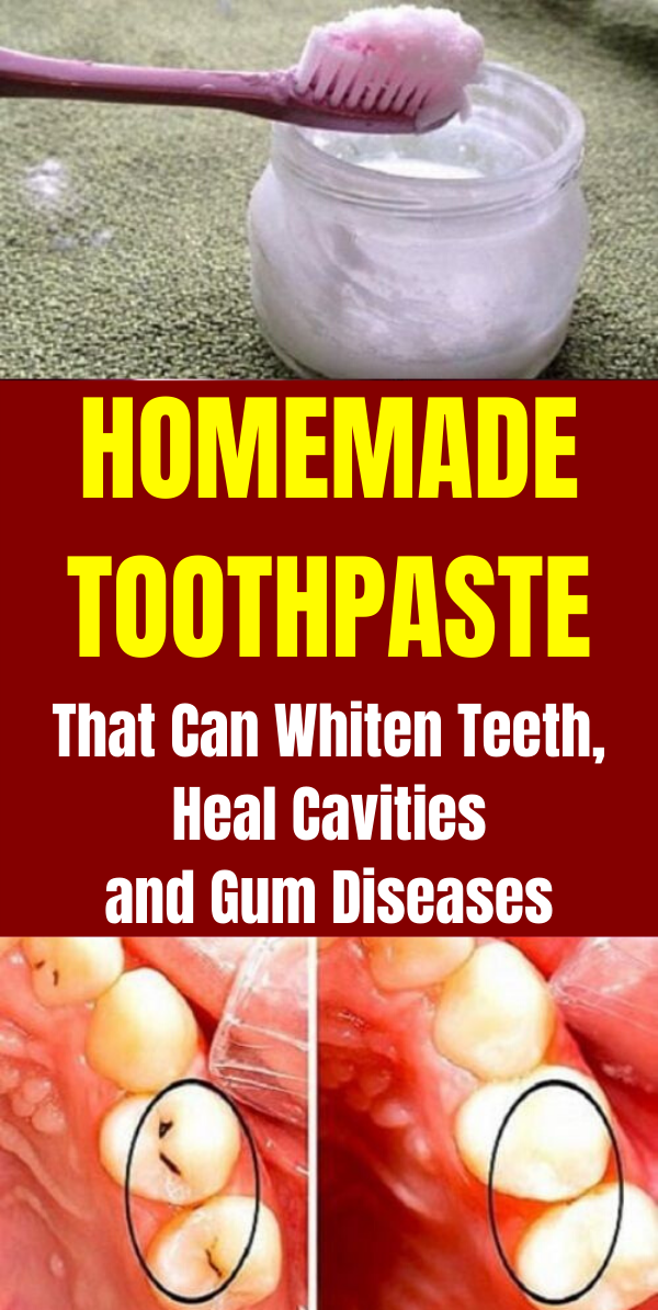 Homemade Toothpaste That Can Whiten Teeth, Heal Cavities and Gum