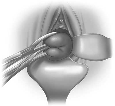 Vaginal mucosa incised circumferentially