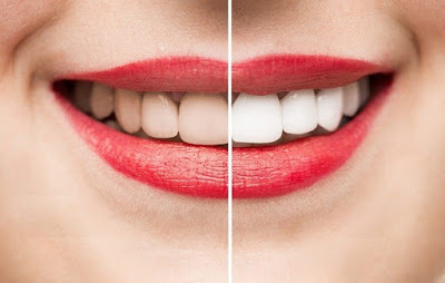 Duy trì màu răng sau khi tẩy trắng