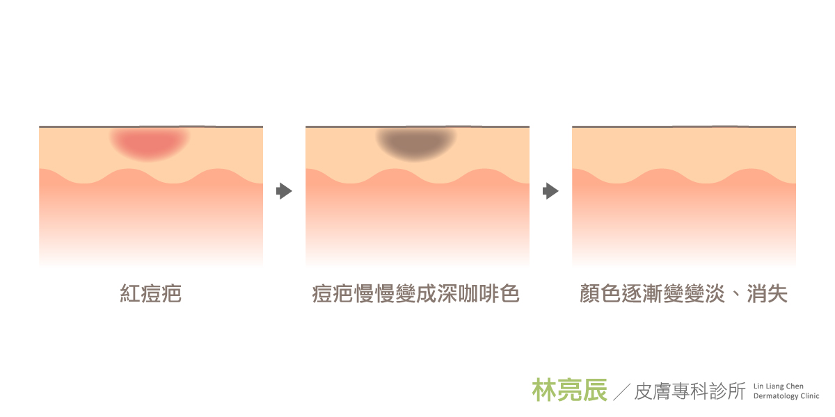 06-紅色痘疤怎麼消?擦藥、雷射、還是不管它? 新竹彩衝光M22彩衝光紅色痘疤ptt紅痘疤多久藥膏雷射消不掉紅痘疤dcard黑痘疤林亮辰皮膚專科診所