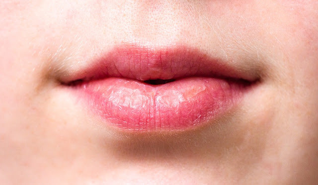 Mengatasi Bibir Kering Secara Alami dan Mudah Mengatasi Bibir Kering Secara Alami dan Mudah