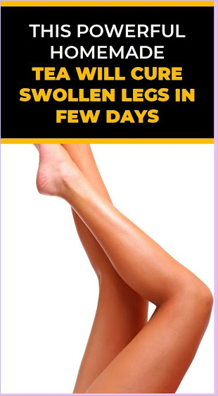 Cure Swollen Legs In Few Days