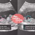 Descobrindo o Sexo do Bebê no primeiro trimestre: Tubérculo Fetal