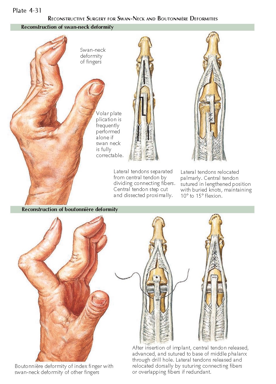DEFORMITIES OF INTERPHALANGEAL JOINT pediagenosis