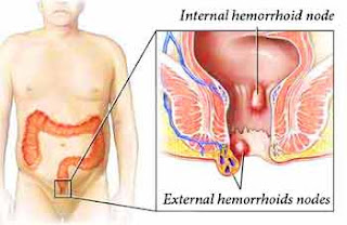 What is a hemroid