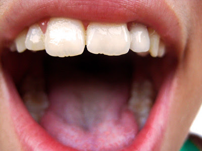 WHO calls for oral health improvement