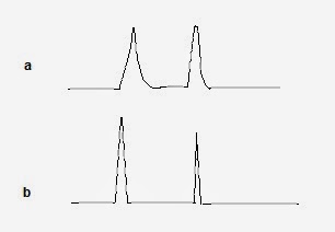 Fig. 1: a) 30 ml injection of sample in acetonitrile. Reversed-phase separation with 18% acetonitrile/water as mobile phase b) same as (a) but the sample is dissolved in the mobile phase and 2 normal peaks appear.