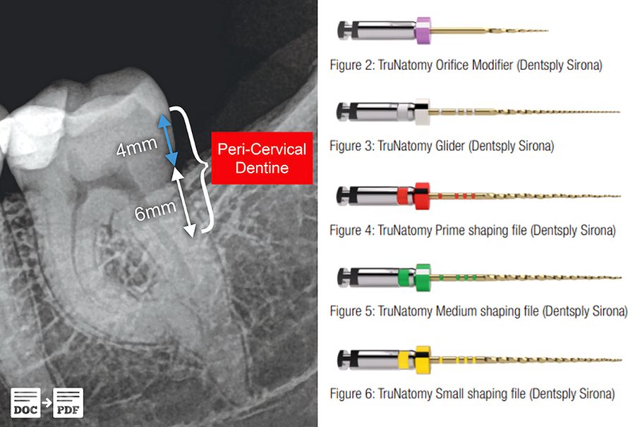 CLINICAL CASE Minimally invasive endodontics using a new singlefile rotary system Ovi Dental Go