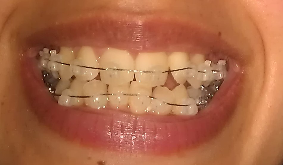 My Damon Clear Braces Day 16 Progress Picture