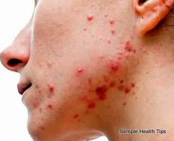 how to cure acne naturally in 3 days in home remedies