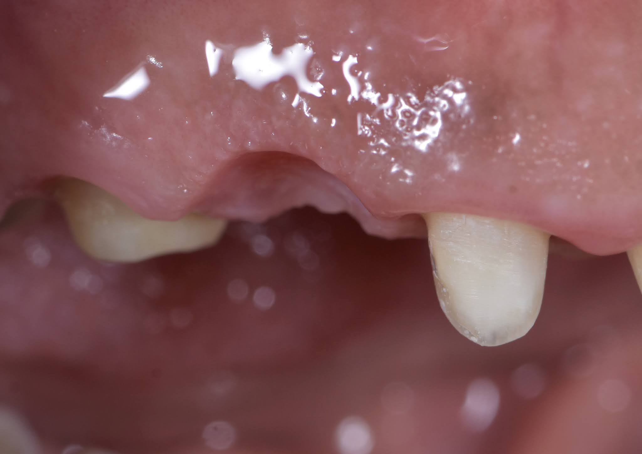 Dental Esthetics Ovate pontic for the correct emergence profile.. A clinical case