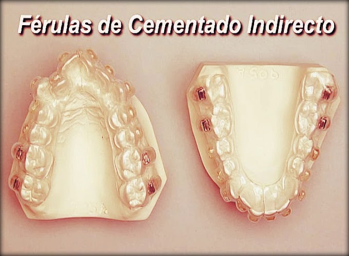 ORTODONCIA: Técnica de Cementado Indirecto de Brackets