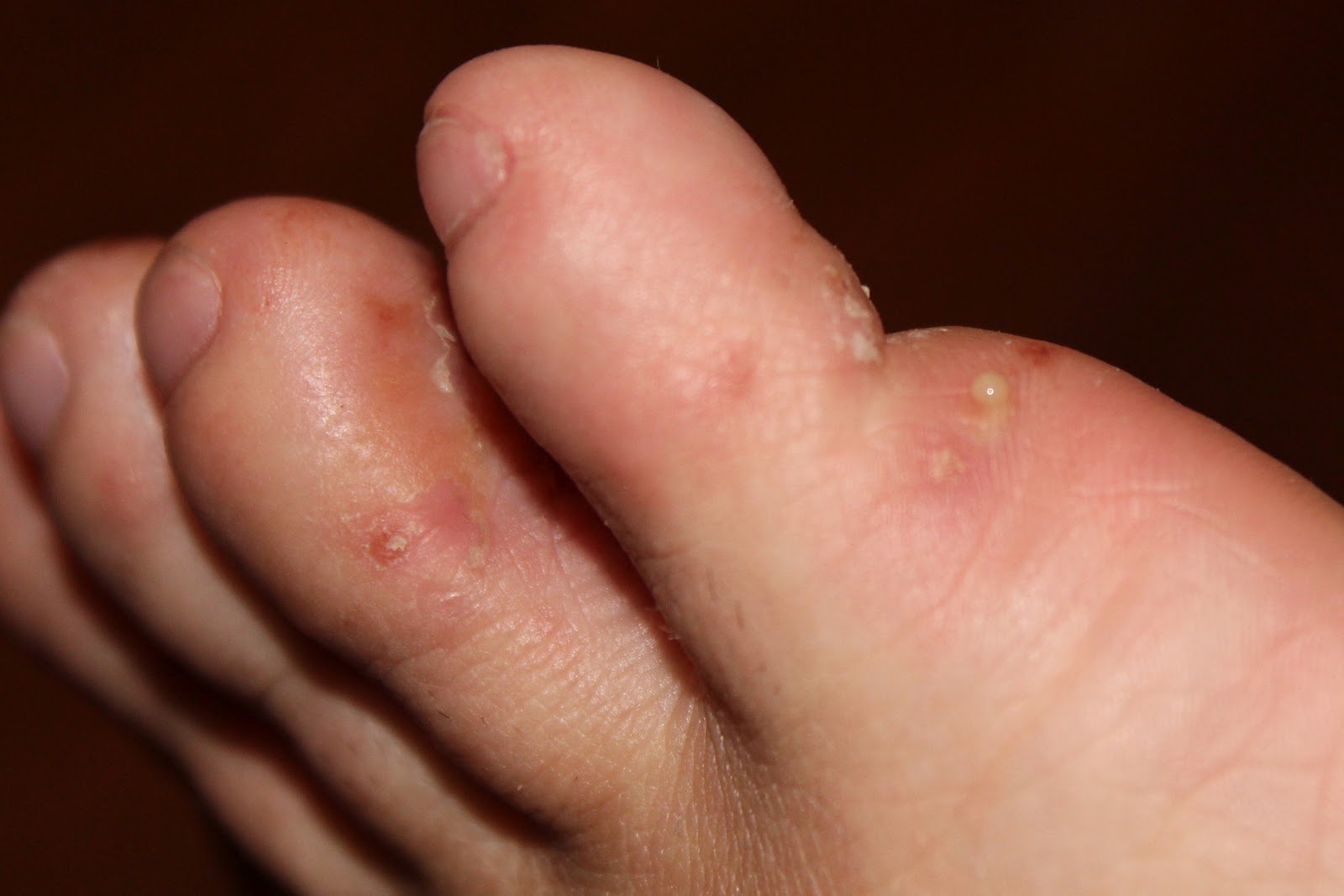 This Is In A Different Phase Of My Foot But You Can See The Deep Set