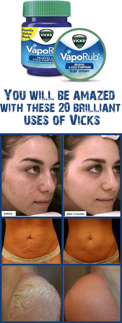 9 Surprising Uses for Vicks VapoRub HEALTHYLIFE
