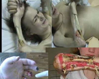 krokodil+side+effect.png