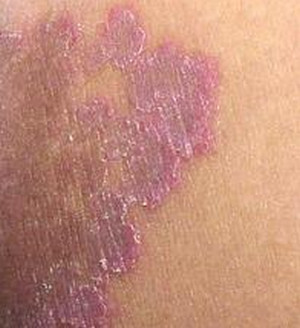 peri area rash