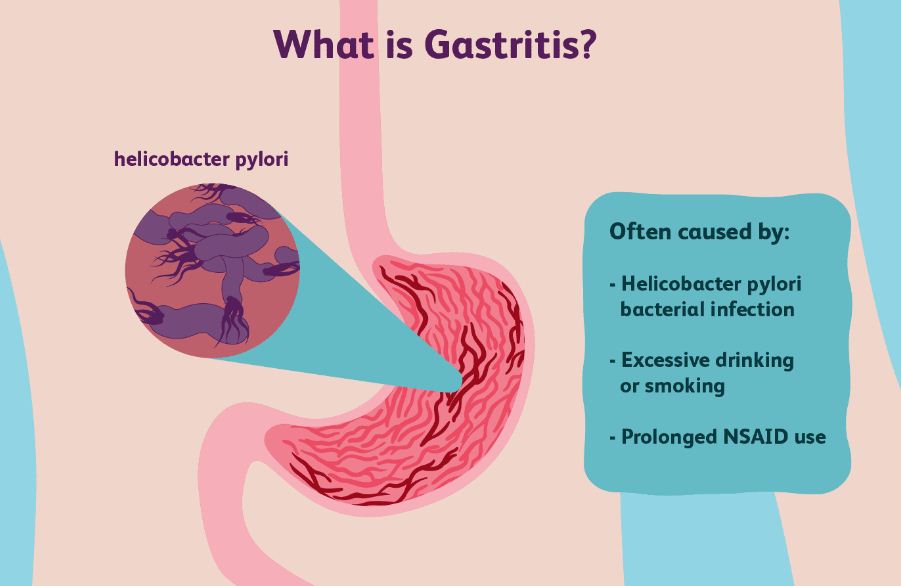 Seorang Wanita Mengalami Gejala Seperti Nyeri Pada Perut Bagian Atas Mual Muntah Dan Diare Serta Demam Pasien Tersebut Memeriksa Diri Ke Dokter Ahli Penyakit Dalam Dan Melakukan Tes Darah Hasil Tes Darahnya