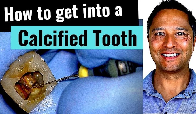 ENDODONTICS: How to get into a Calcified Tooth