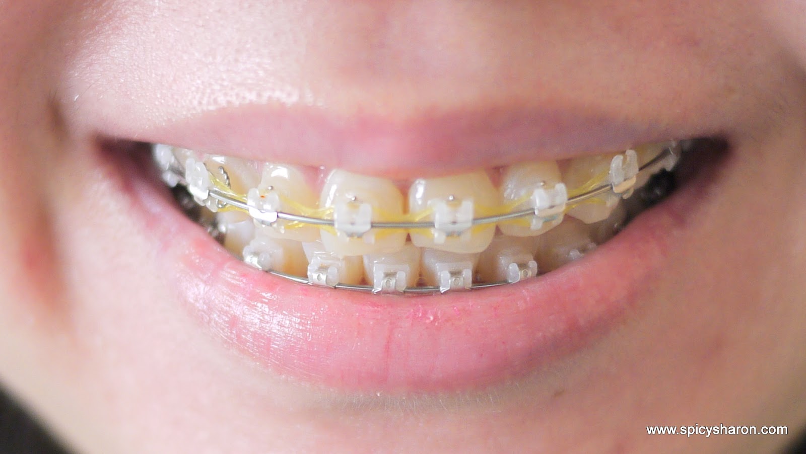 [Part 2] My Braces Journey with 32 Pearls Dental GLO Damansara