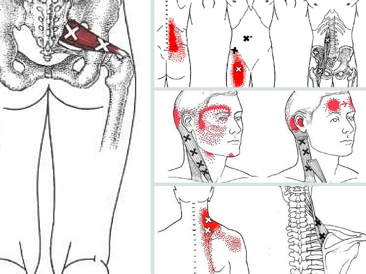 миофасциальный болевой синдром массаж. миофасциальный синдром мышц спины. триггерные точки схема. клэр дэвис, амбер дэвис. триггерная точка 4.