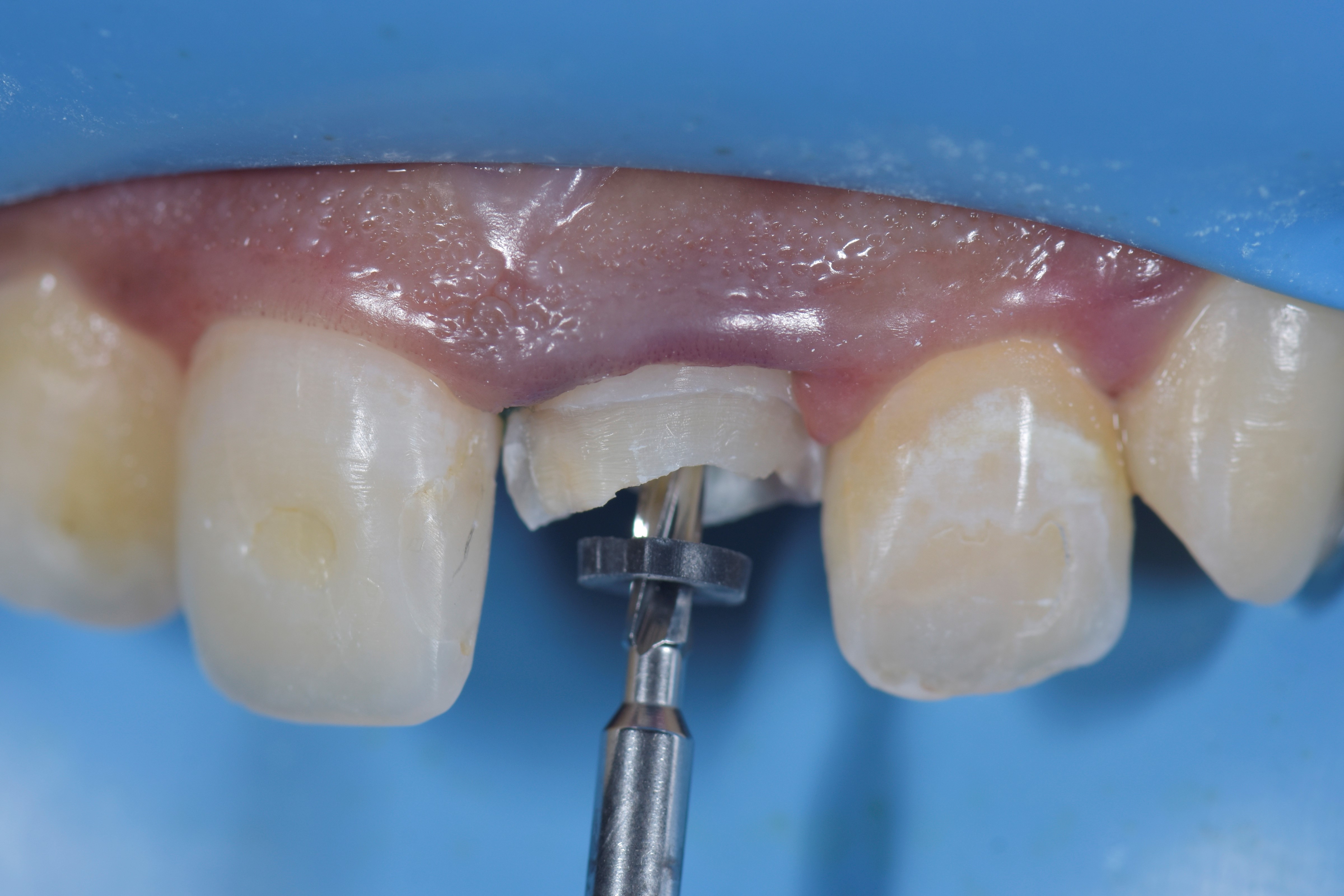 Inverse injection of composite over a fiber post Dental Esthetics